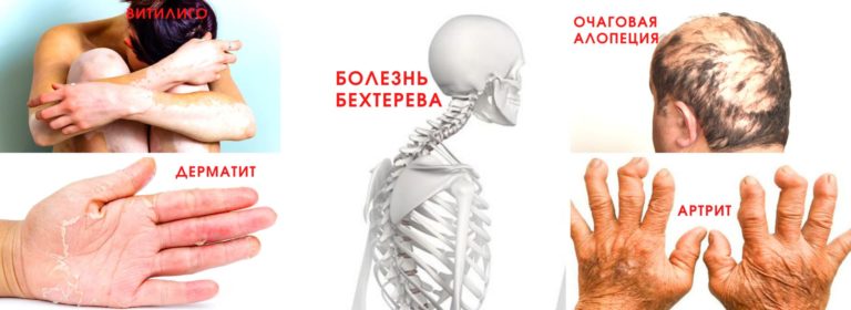 Причина аутоиммунных заболеваний: 3 аспекта кишечного иммунитета 7 prichina autoimmunnyh zabolevanij